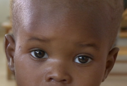 Malnourished Children in Haiti